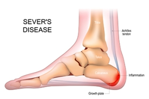 Heel Pain in Children May Indicate Sever’s Disease