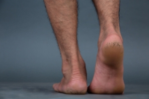 What Causes Cracked Heels?