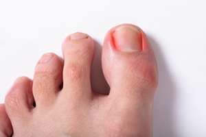 Can My Baby Develop an Ingrown Toenail?