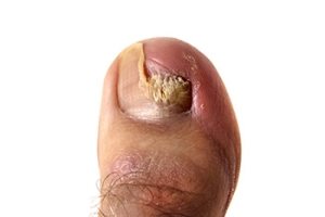 When Toenails Change Color and Texture