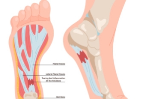 Heel Pain May Indicate Plantar Fasciitis