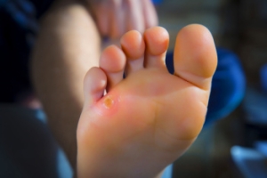 What Are Foot Corns?