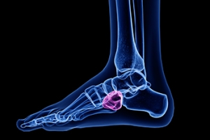 What Is a Cuboid Stress Fracture?